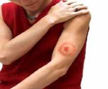 Ključne karakteristike krpelja-prenese borreliosis, metode liječenja